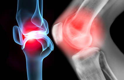 Joints arthrosis